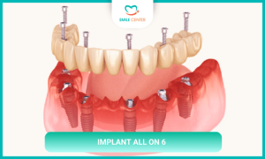 Ưu điểm của trồng răng Implant toàn hàm All On 6