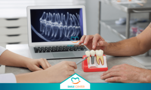 Hiểu rõ về trồng răng Implant