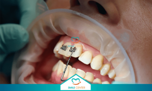 Quy trình niềng răng không đau chuẩn y khoa