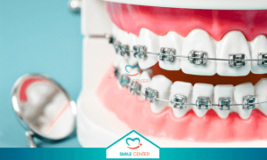 Người niềng răng bạn cần biết những gì để đạt hiệu quả cao?