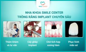 Quy trình trồng răng implant trọn gói