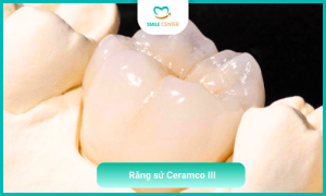 Răng sứ Ceramco III là gì ?