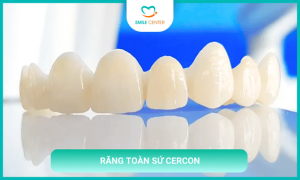 Răng toàn sứ Cercon là gì?