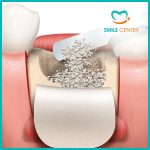 Tại sao cần ghép xương trong trồng răng implant?