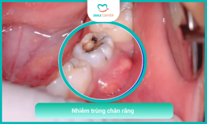 Bệnh lý về răng hàm mặt - Nhiễm trùng chân răng