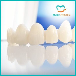 Niềng răng là gì? Các phương pháp niềng răng phổ biến nhất hiện nay