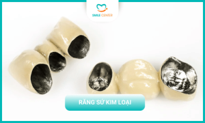 Răng sứ kim loại là gì?