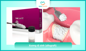 Xương dị sinh (allograft)