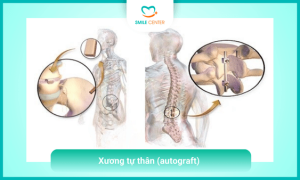 Xương tự thân (autograft)