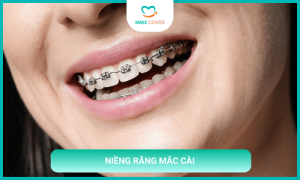 Niềng răng mắc cài kim loại