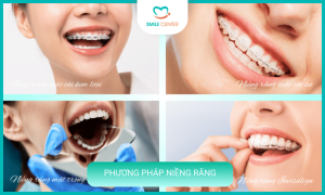 Phương pháp niềng răng cho người lớn