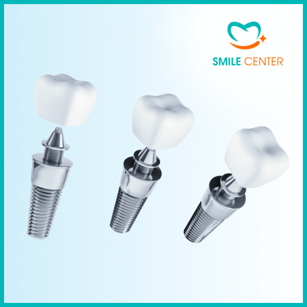 Thời gian làm răng Implant