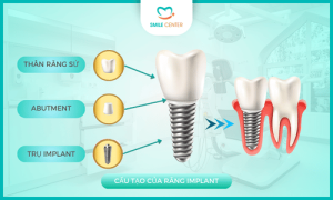 Tổng quan về cấy ghép răng Implant