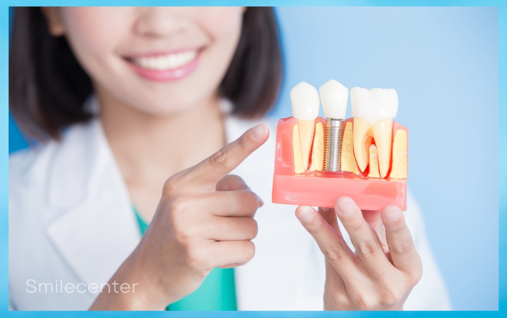 Cấy ghép implant