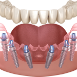 IMPLANT-ALL-ON-6-150x150